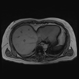 File:Acute cholecystitis (Radiopaedia 72392-82923 Axial T1 out-of-phase 24).jpg