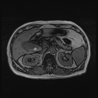 File:Acute cholecystitis (Radiopaedia 72392-82923 Axial T1 out-of-phase 51).jpg