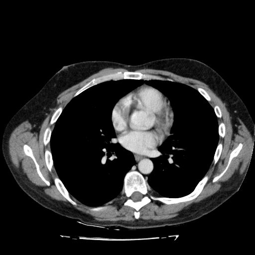 File:Acute cholecystitis and incidental left sided IVC (Radiopaedia 49352-54459 Axial C+ portal venous phase 7).jpg