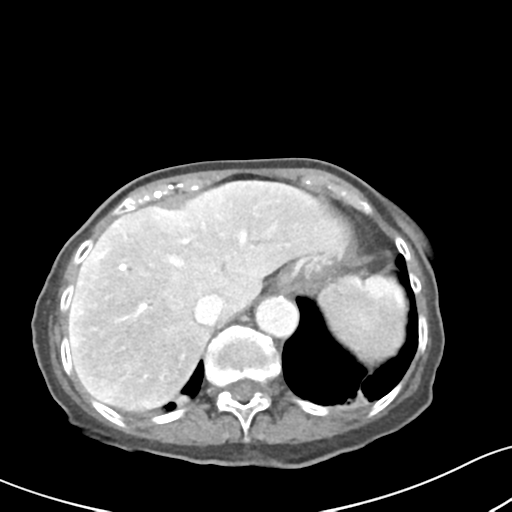 File:Acute cholecystitis with contained perforation (Radiopaedia 47328-51907 Axial C+ portal venous phase 14).png