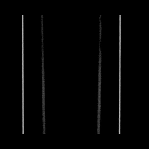 Acute cholecystitis with tensile fundus sign (Radiopaedia 71394-81723 Coronal non-contrast 136).jpg