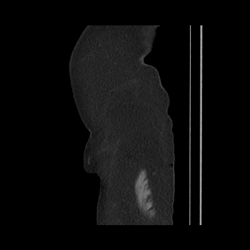 Acute cholecystitis with tensile fundus sign (Radiopaedia 71394-81723 Sagittal non-contrast 24).jpg