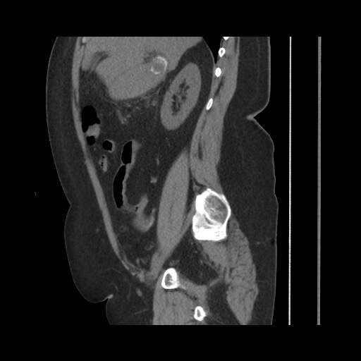 Acute cholecystitis with tensile fundus sign (Radiopaedia 71394-81723 Sagittal non-contrast 68).jpg