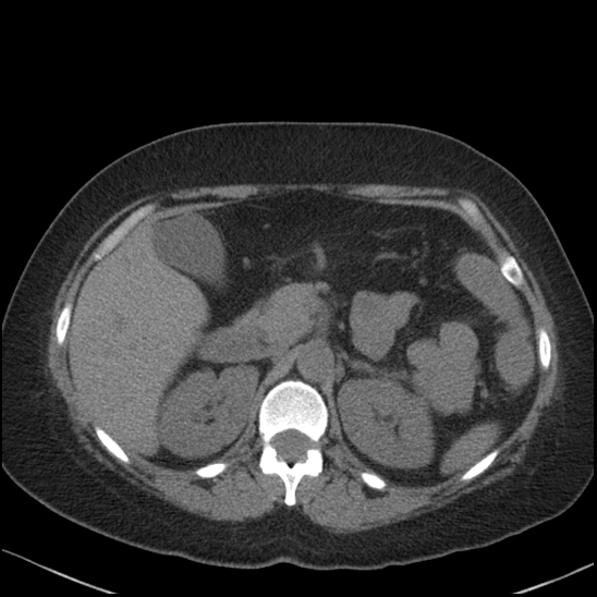 Acute colonic hemorrhage in ulcerative colitis (Radiopaedia 77415-89538 Axial non-contrast 42).jpg