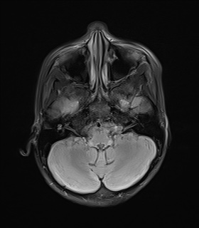 File:Acute disseminating encephalomyelitis with bilateral optic neuritis (Radiopaedia 79676-92886 Axial FLAIR 6).jpg