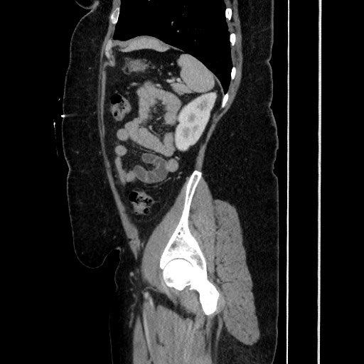 Acute diverticulitis - transverse colon (Radiopaedia 87063-103327 Sagittal C+ portal venous phase 166).jpg