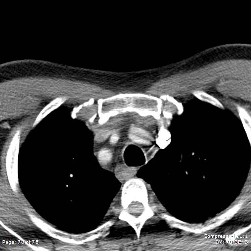 Acute epiglottitis (Radiopaedia 54375-60590 Axial C+ arterial phase 70).jpg