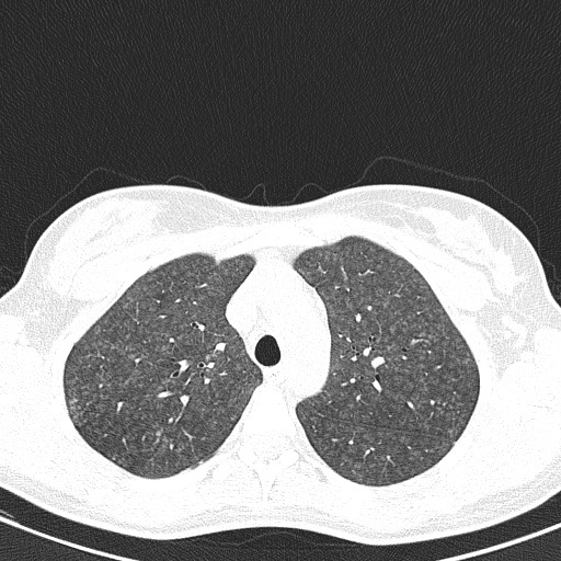 File:Acute hypersensitivity pneumonitis (Radiopaedia 85293-100870 Axial lung window 29).jpg