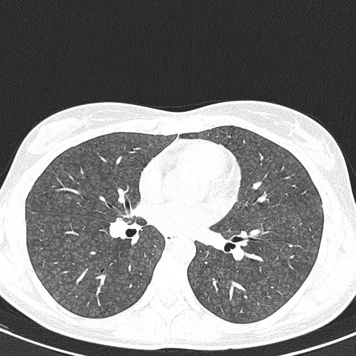File:Acute hypersensitivity pneumonitis (Radiopaedia 85293-100870 Axial lung window 63).jpg