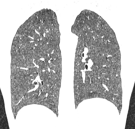 File:Acute hypersensitivity pneumonitis (Radiopaedia 85293-100870 Coronal lung window 90).jpg