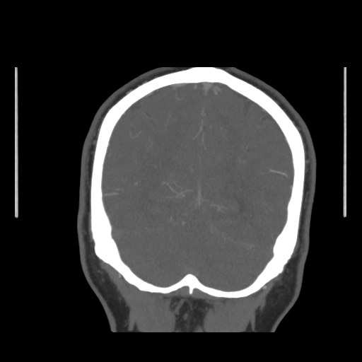 Acute internal carotid artery dissection (Radiopaedia 53541-59630 E 66).jpg