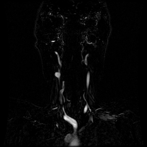 Acute internal carotid artery dissection (Radiopaedia 53541-59632 Coronal MRA 63).jpg