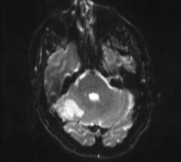 Acute ischemic stroke - posterior circulation territory (Radiopaedia 77670-89880 Axial DWI 7).jpg