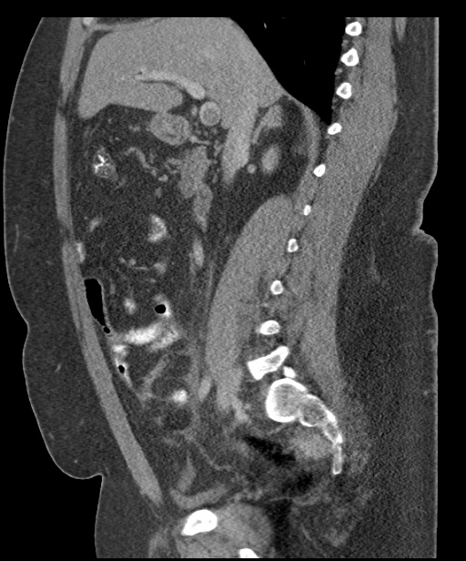 Acute mesenteric venous ischemia (Radiopaedia 46041-50383 Sagittal C+ portal venous phase 48).jpg
