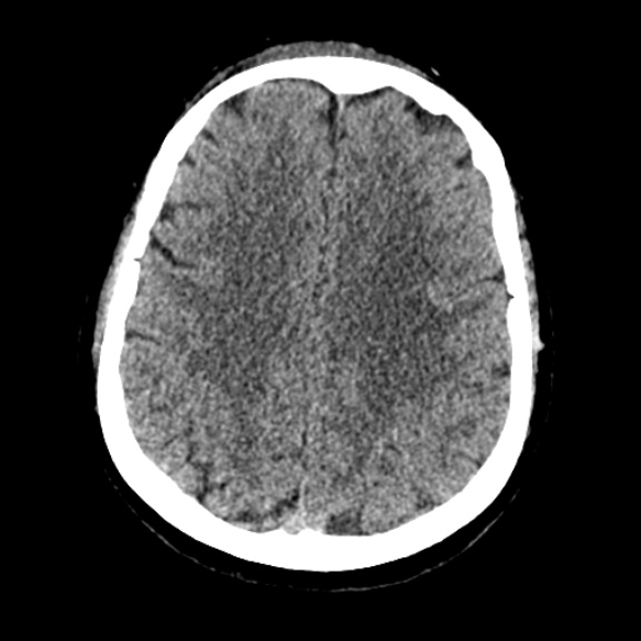 Acute middle cerebral artery territory infarct (Radiopaedia 52380-58283 Axial non-contrast 71).jpg