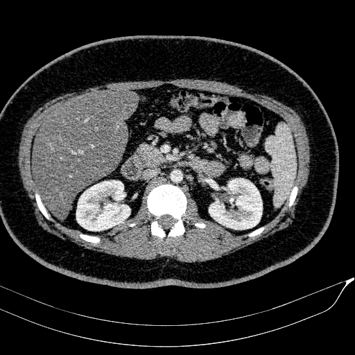 File:Acute on chronic pancreatitis (Radiopaedia 80902-94423 Axial C+ portal venous phase 72).jpg