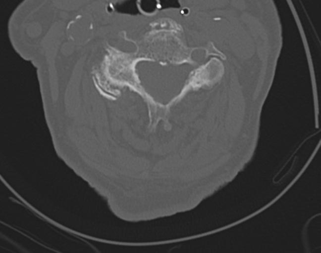 Acute on chronic subdural hematoma and thoracic vertebral injury in a multitrauma patient (Radiopaedia 31698-32619 Axial bone window 30).jpg