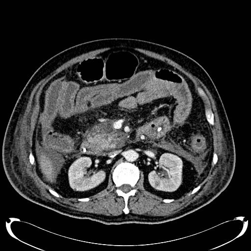 Acute pancreatic necrosis (Radiopaedia 13560-18500 Axial C+ portal venous phase 65).jpg