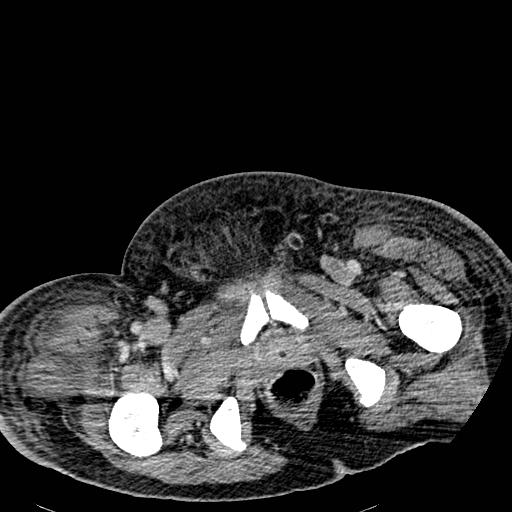 Acute pancreatic necrosis (Radiopaedia 13560-18501 Axial C+ portal venous phase 153).jpg