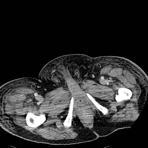 File:Acute pancreatic necrosis (Radiopaedia 13560-18501 Axial C+ portal venous phase 160).jpg