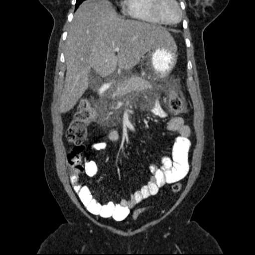 File:Acute pancreatitis (Radiopaedia 20829-20744 Coronal C+ portal venous phase 19).jpg