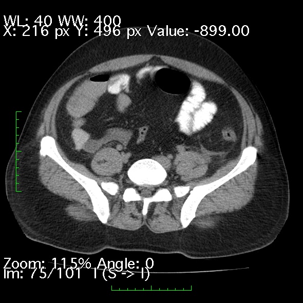 Acute pancreatitis (Radiopaedia 34043-35276 Axial non-contrast 75).jpg