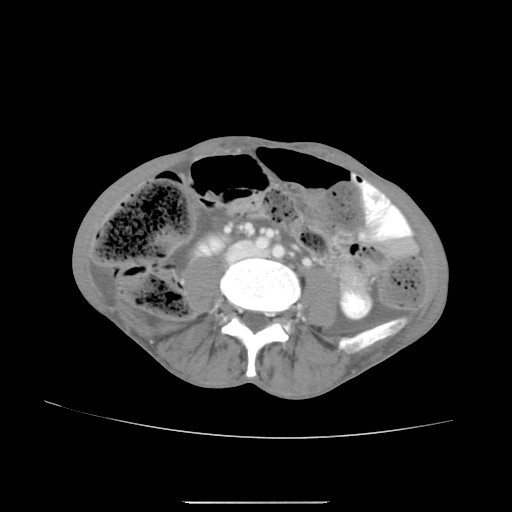 File:Acute pancreatitis (Radiopaedia 50213-55558 Axial C+ portal venous phase 32).jpg