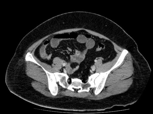 Acute pancreatitis (Radiopaedia 69236-79012 Axial C+ portal venous phase 71).jpg