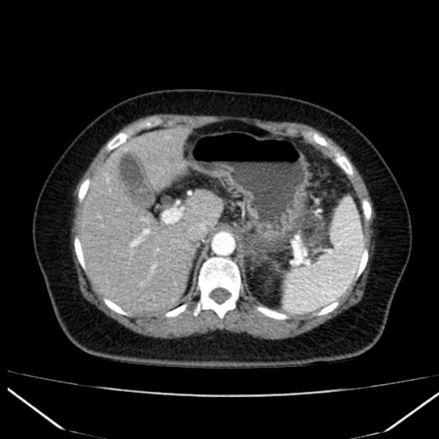 Acute pancreatitis - Balthazar C (Radiopaedia 26569-26714 Axial C+ arterial phase 23).jpg