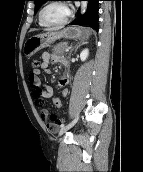 Acute pancreatitis - Balthazar E (Radiopaedia 23080-23110 Sagittal C+ portal venous phase 64).jpg
