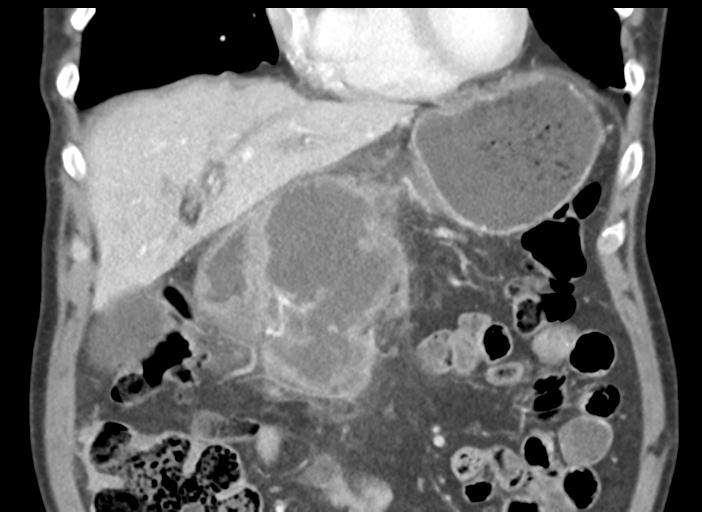 Acute pancreatitis and walled-off necrosis (Radiopaedia 29888-30404 Coronal C+ portal venous phase 18).jpg