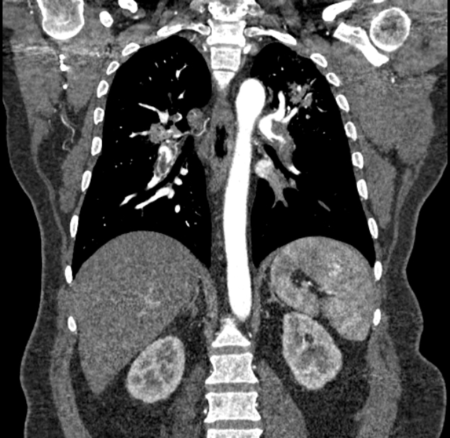 Acute pulmonary embolism with pulmonary infarcts (Radiopaedia 77688-89908 Coronal C+ CTPA 63).jpg