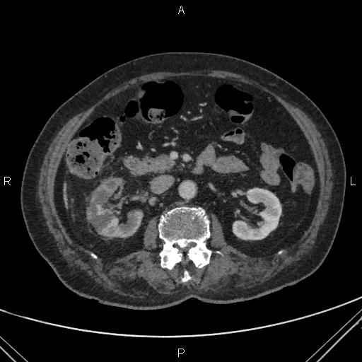 Acute renal artery occlusion (Radiopaedia 86586-102682 Axial C+ portal venous phase 34).jpg