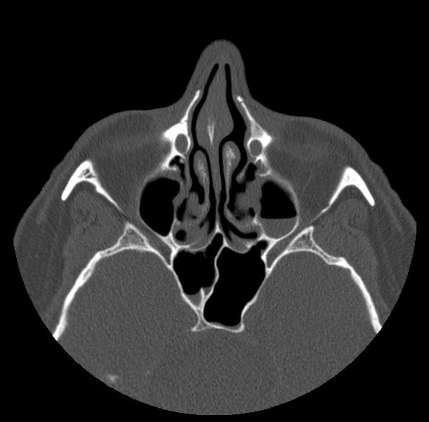 Acute sinusitis (Radiopaedia 23161-23215 Axial bone window 35).jpg