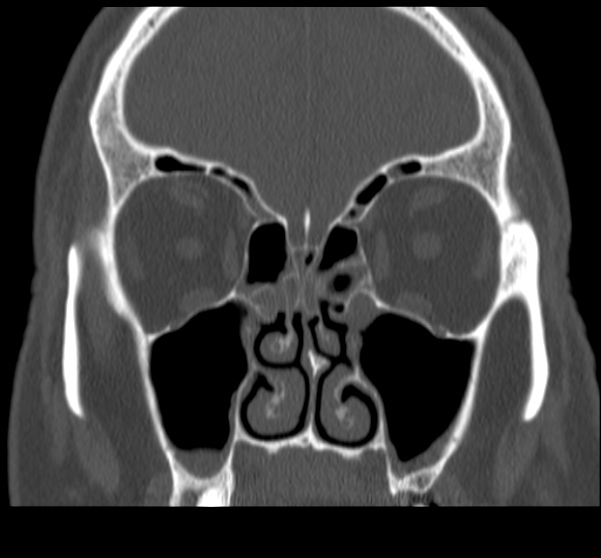 Acute sinusitis (Radiopaedia 23161-23215 Coronal bone window 34).jpg
