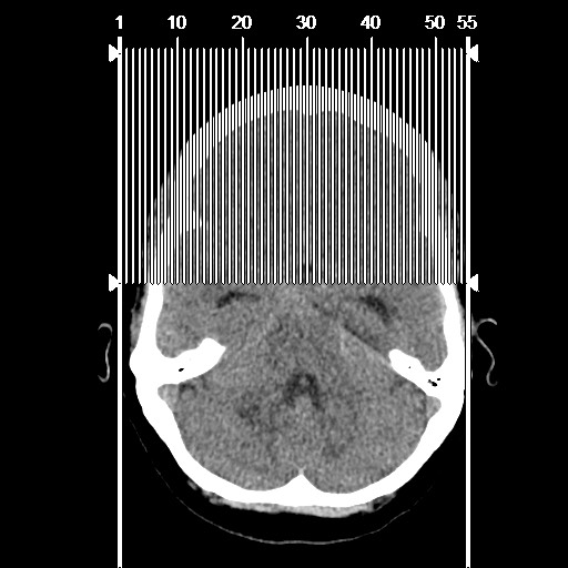 Acute subarachnoid hemorrhage and accessory anterior cerebral artery (Radiopaedia 69231-79008 Sagittal non-contrast 1).jpg