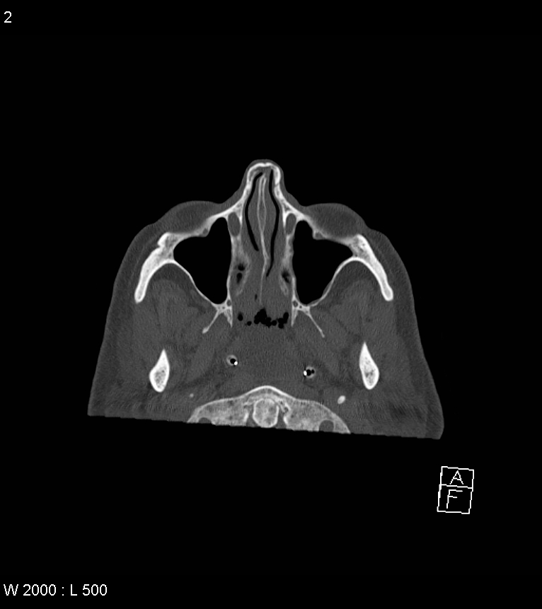 Acute subdural hematoma with myelofibrosis (Radiopaedia 52582-58494 Axial bone window 1).jpg