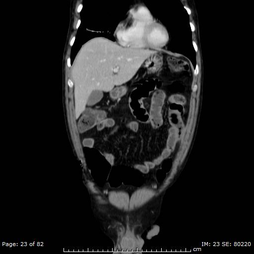 Acute superior mesenteric artery occlusion (Radiopaedia 43636-47060 Coronal C+ portal venous phase 8).jpg