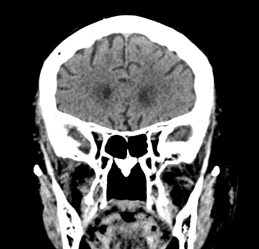 File:Acute traumatic subdural hematoma (Radiopaedia 82921-97257 Coronal non-contrast 34).jpg
