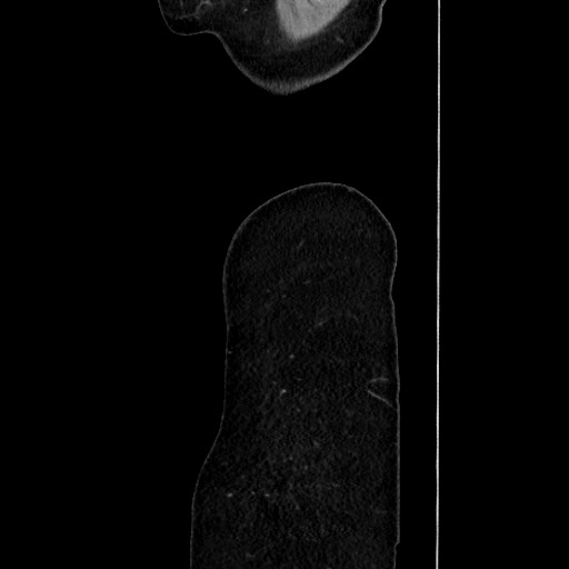 Acute uncomplicated appendicitis (Radiopaedia 73704-84499 Sagittal C+ portal venous phase 195).jpg