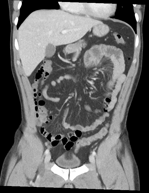Acute uncomplicated appendicitis (Radiopaedia 88350-104982 Coronal C+ portal venous phase 19).png