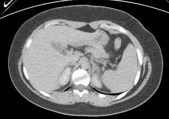 Acute unilateral nonhemorrhagic adrenal infarction (Radiopaedia 67560-76957 Axial renal excretory phase 23).jpg