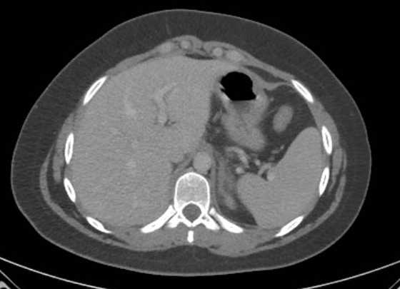 Acute unilateral nonhemorrhagic adrenal infarction (Radiopaedia 67560-76957 Axial renal parenchymal phase 13).jpg