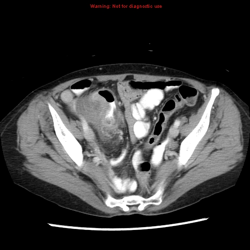 Adenocarcinoma of the colon (Radiopaedia 8191-9039 Axial liver window 62).jpg