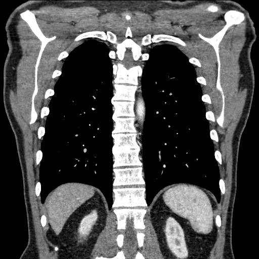 Adenocarcinoma of the lung (Radiopaedia 59871-67325 Coronal C+ arterial phase 55).jpg
