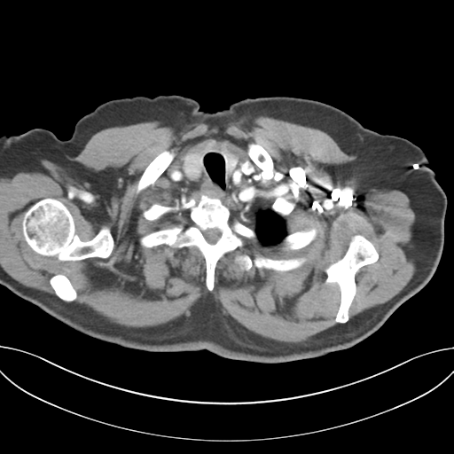 Adenocarcioma of rectum- T1 lesion (Radiopaedia 36921-38547 Axial C+ arterial phase 7).png
