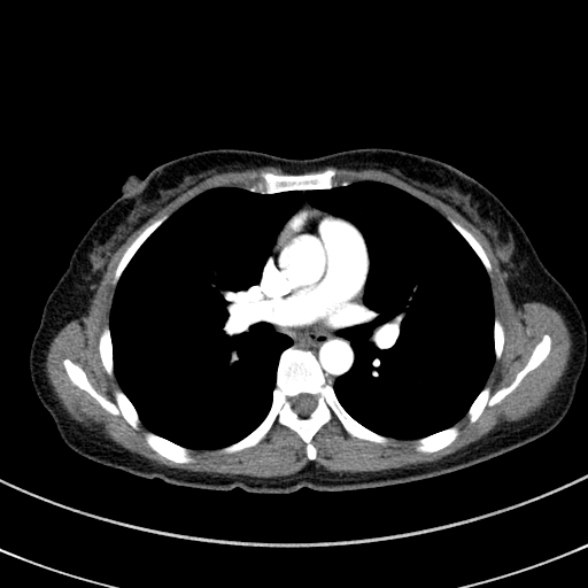 Adenocystic carcinoma of the trachea (Radiopaedia 47677-52525 Axial C+ arterial phase 51).jpg
