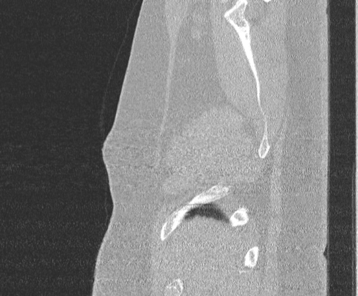Adenoid cystic carcinoma of the trachea (Radiopaedia 49042-54137 Sagittal lung window 27).jpg