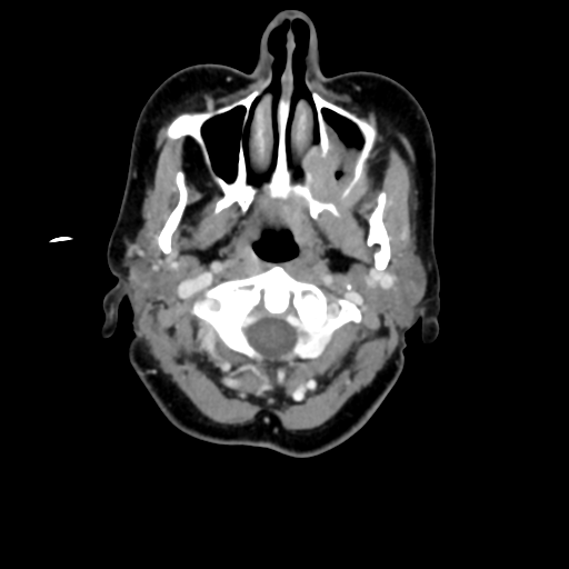 File:Adenoid cystic tumor of palate (Radiopaedia 46980-51518 Axial C+ delayed 26).png