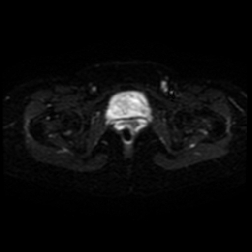 Adenoma malignum of cervix (Radiopaedia 66441-75705 Axial DWI 19).jpg